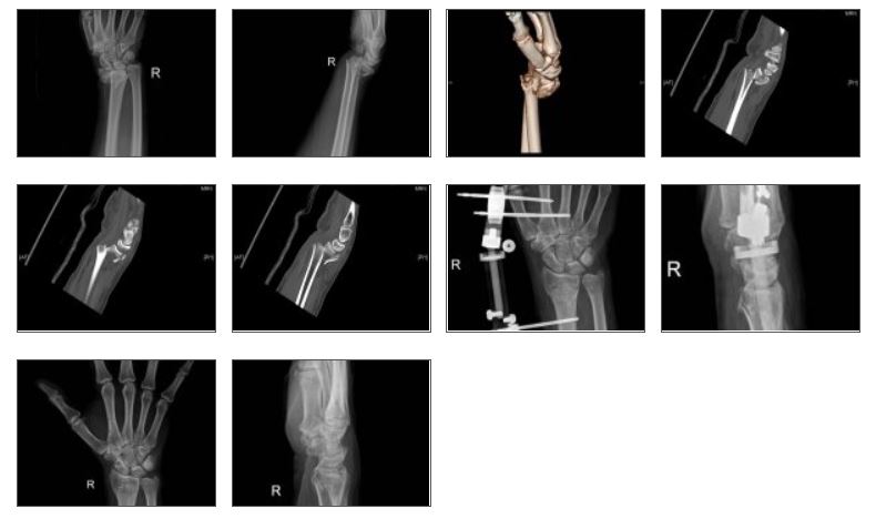 Prof. Dr. Levent ERALP Radius Distal Edge Partial Fracture