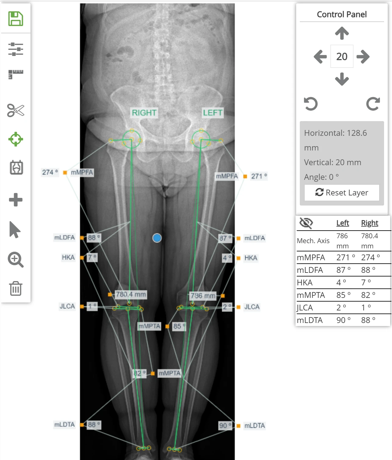 Smart Fixator planlama yazılımında uzun bacak grafisinde işaretlenen anatomik noktalar ve hesaplanan açılar