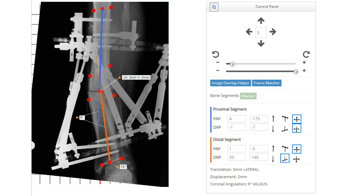 Smart Fixator radyografik dijital planlama ekranı